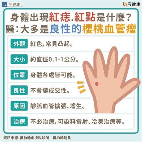 紅色痣代表什麼|皮膚長「紅痣」會怎樣？跟黑痣有何不同？會是皮膚癌。